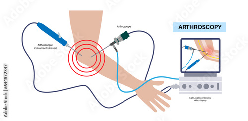 Elbow arthroscopy surgery