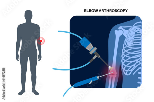 Elbow arthroscopy surgery