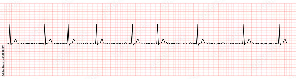 EKG Monitor Showing Atrial Fibrillation With Normal Ventricular Response