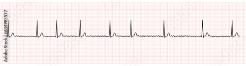 EKG Monitor Showing Atrial Fibrillation With Normal Ventricular Response