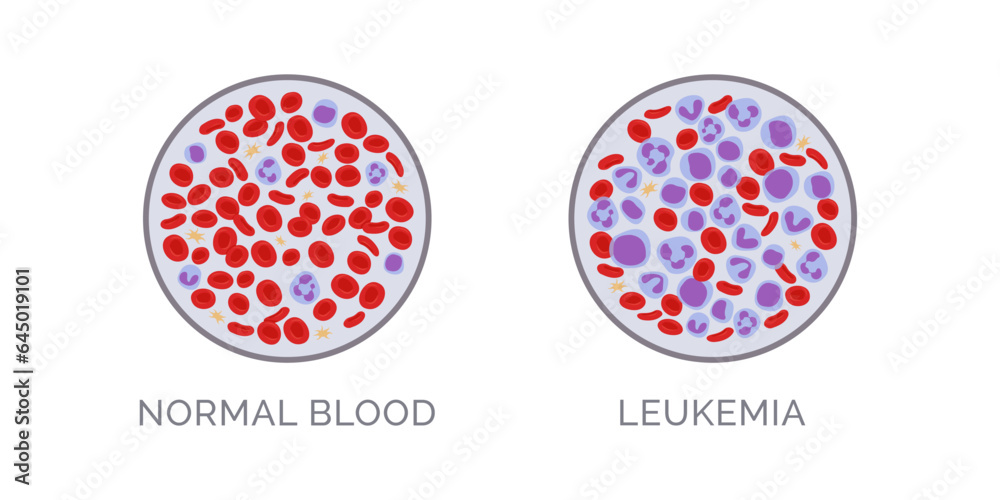 Blood Test Comparison Normal And Leukemia Stock Vector Adobe Stock Blood Test Comparison Normal And Leukemia Stock Vector Adobe Stock