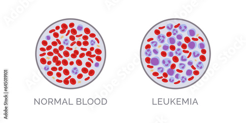 Blood test comparison: normal and leukemia