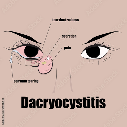 Dacryocystitis is infection of the lacrimal sac, which sometimes leads to abscess formation.