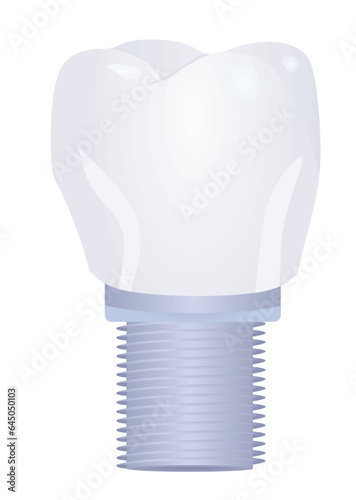 Tooth implant model. vector illustration