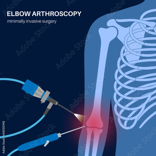 Elbow arthroscopy surgery