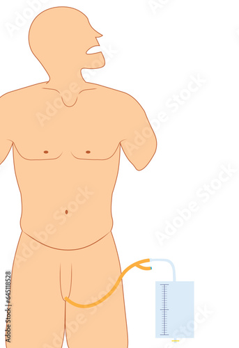 Human illustration with Foley catheter and urinary bag