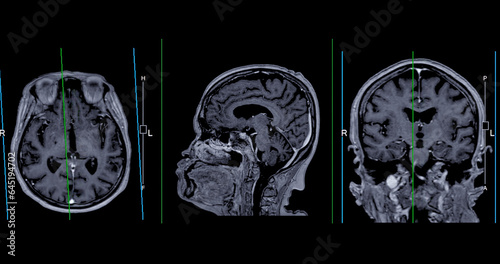 MRI  brain scan Axial , Coronal and sagittal view with referance line for detect  Brain  diseases sush as stroke disease, Brain tumors and Infections. photo
