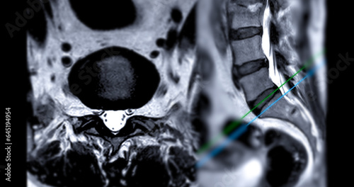 MRI L-S spine or lumbar spine Axial and sagittal T2 technique with reference line  for diagnosis spinal cord compression. photo