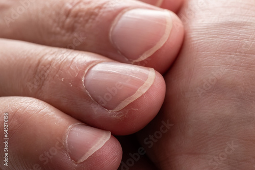 Macro photo of vertical ridges in fingernails © eliosdnepr