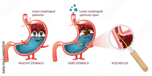 Stomach cartoon characters healthy and GERD with faces and emotions