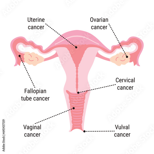 Gynecological Cancer Awareness Month infographic. Main types of cancer cervical, ovarian, uterine, vaginal and vulvar in woman reproductive organs. Cancer prevention, women health illustration photo