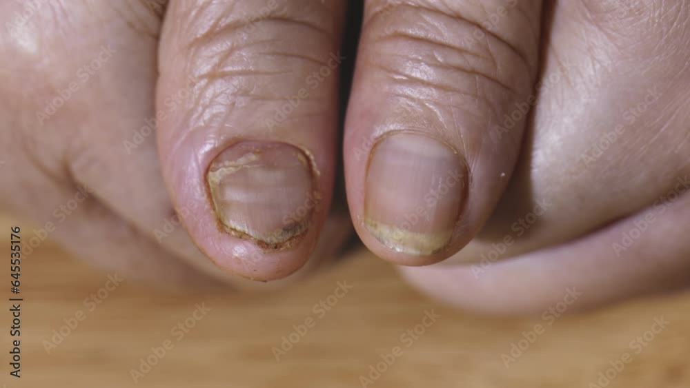 Cancer chemotherapy cause swelling of hand ,
skin to become dry, dark or peel and nails brittle and flaky. Cancer chemotherapy cause swelling of hand ,
skin to become dry, dark or peel and nails brittle and flaky.