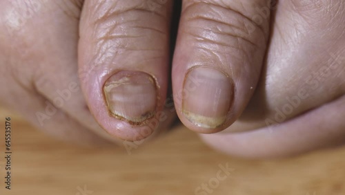 Cancer chemotherapy cause swelling of hand , 
 skin to become dry, dark or peel and nails brittle and flaky. photo