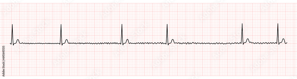 EKG Monitor Showing Atrial Fibrillation With Slow Ventricular Response EKG Monitor Showing Atrial Fibrillation With Slow Ventricular Response