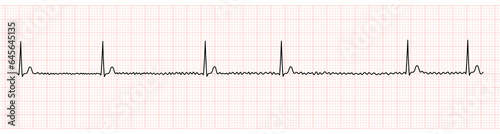 EKG Monitor Showing Atrial Fibrillation With Slow Ventricular Response photo