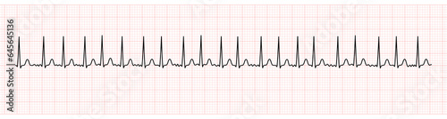 EKG Monitor Showing Atrial Fibrillation With Rapid Ventricular Response