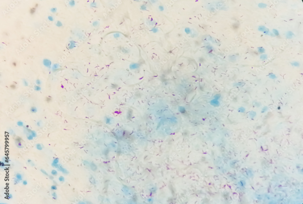 Photomicrograph of Sputum or phlegm smear AFB showing Microbacterium Tuberculosis Bacteria (MTB).