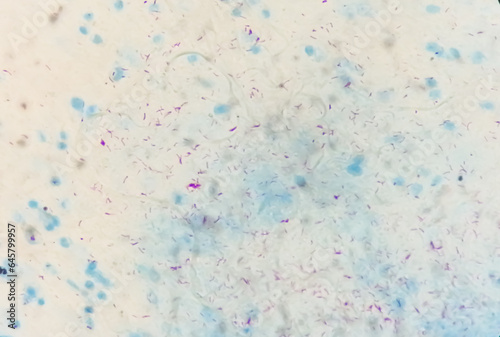 Photomicrograph of Sputum or phlegm smear AFB showing Microbacterium Tuberculosis Bacteria (MTB). photo