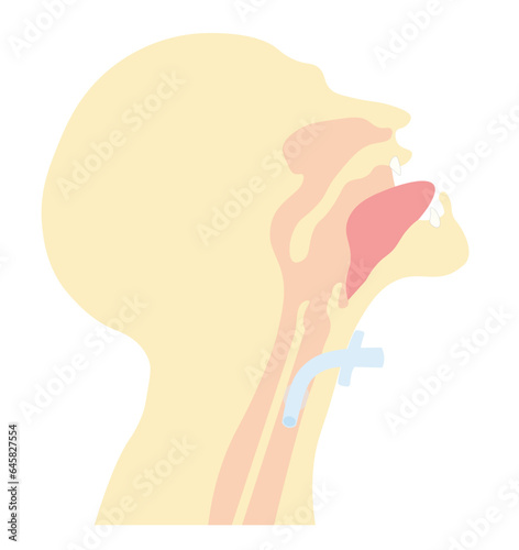 Side view of a human airway anatomy with a tracheostomy tube 