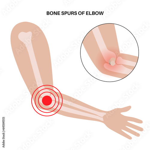 Bone spurs of elbow