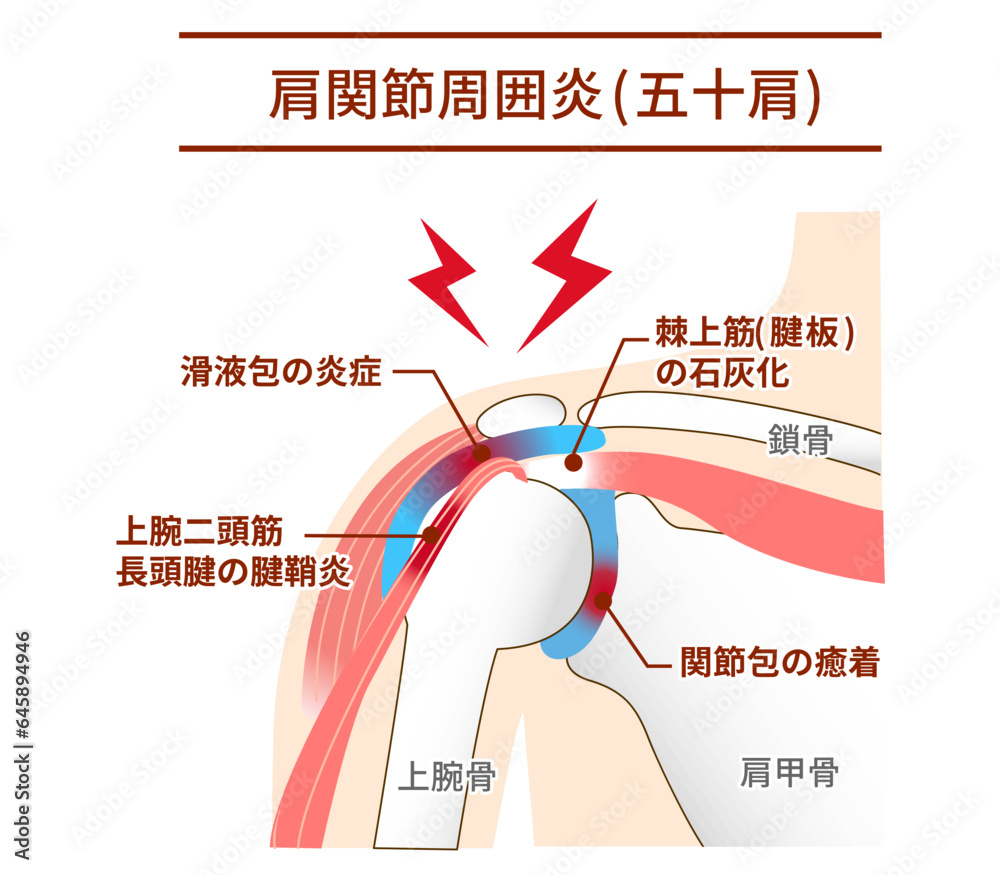 肩関節周囲炎(五十肩)とは何ですか? – 肩関節周囲炎を治すにはどうしたらいいの – ITWL