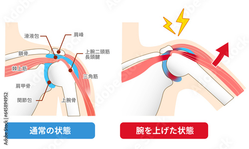 インピンジメント症候群。腕を上げた時に痛みを感じる原因と仕組み