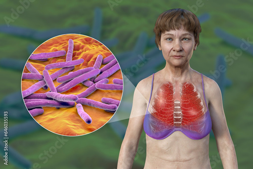 A female patient with lungs affected by miliary tuberculosis and close-up view of Mycobacterium tuberculosis bacteria, 3D illustration photo