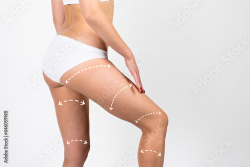 Cellulite removal scheme on body girl. White arrows markings on belly and leg young girl.