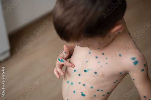 The boy points his finger at the spots on the skin that is cured with brilliant green antiseptic.  Chickenpox or varicella zoster virus. Treatment with brilliant green photo