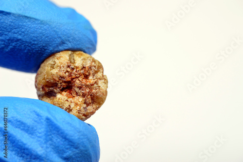 Large gallstone removed surgically after laparoscopic cholecystectomy, Gallstones are hardened deposits of digestive fluid that can form in gallbladder with two types, cholesterol and pigment stones photo