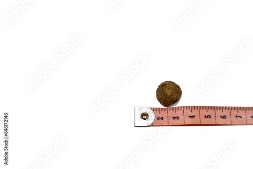 Large gallstone removed surgically after laparoscopic cholecystectomy, Gallstones are hardened deposits of digestive fluid that can form in gallbladder with two types, cholesterol and pigment stones photo