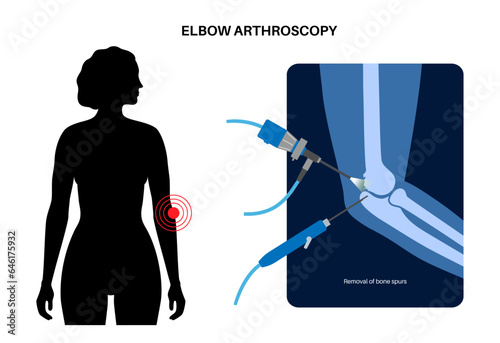 Elbow arthroscopy surgery