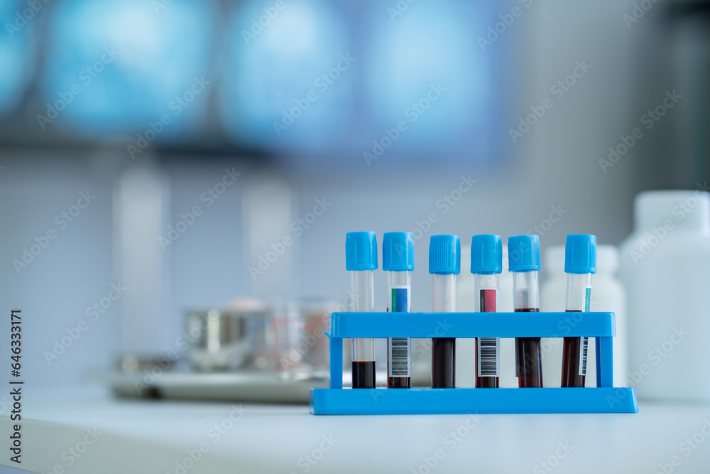 lab technician with a tube of blood samples and a rack with other samples lab technician holding blood tube sample for the study.