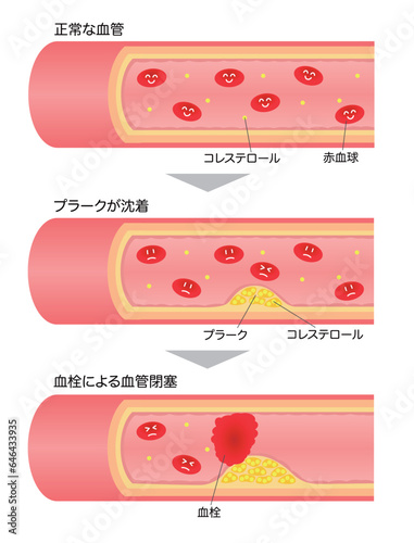 	進行する動脈硬化の断面図の説明イラスト（顔付き赤血球）
