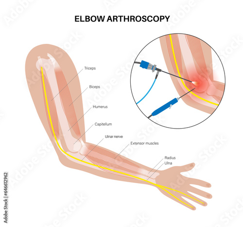 Elbow arthroscopy surgery