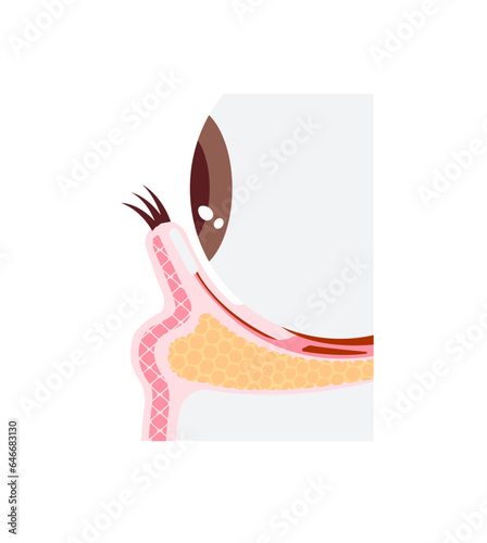 Mechanism of dark circles caused by aging. Vector illustration of cross section ( no text )
