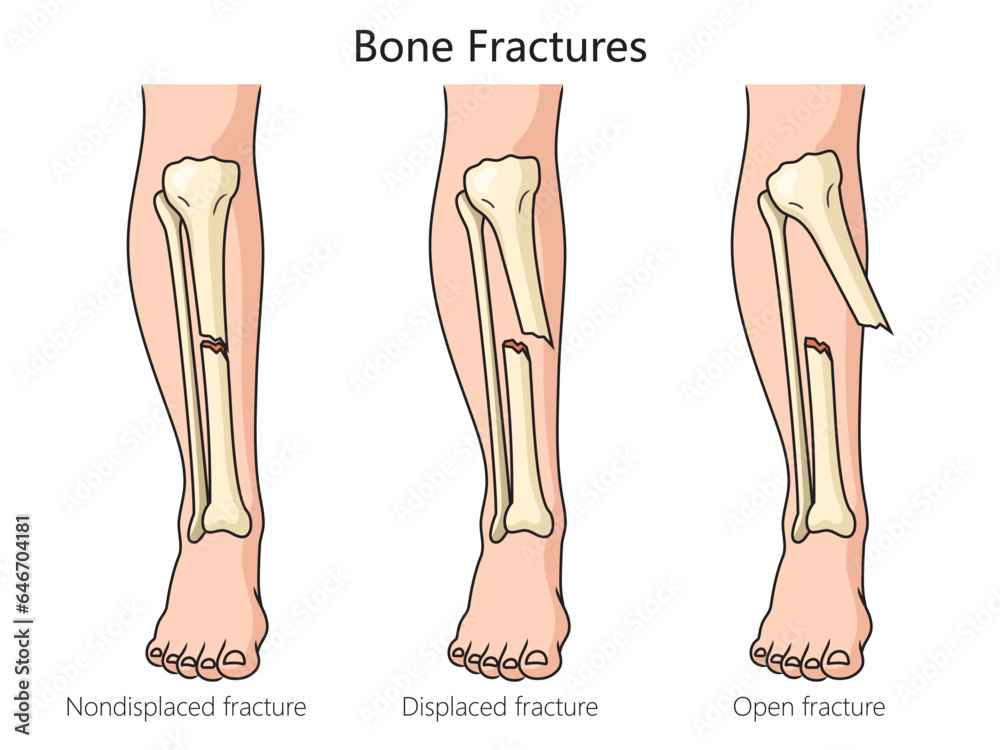 Types of bone fractures diagram schematic vector illustration – Poszter ...