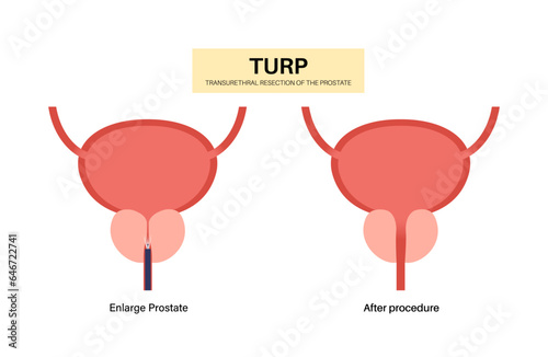 Transurethral resection of the prostate