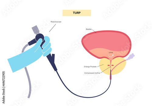 Transurethral resection of the prostate photo