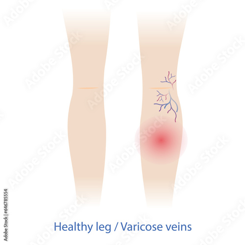 Comparison of healthy and varicose veins on the woman legs vector illustration isolated on white background. Varicose and spider veins are swollen, twisted and pain, making them show under the skin.