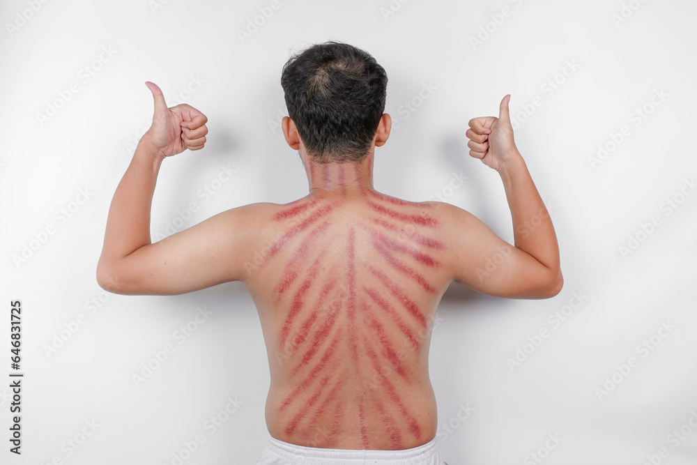 Red marks from scrapes coin on a man's back. Kerokan is a way of ...