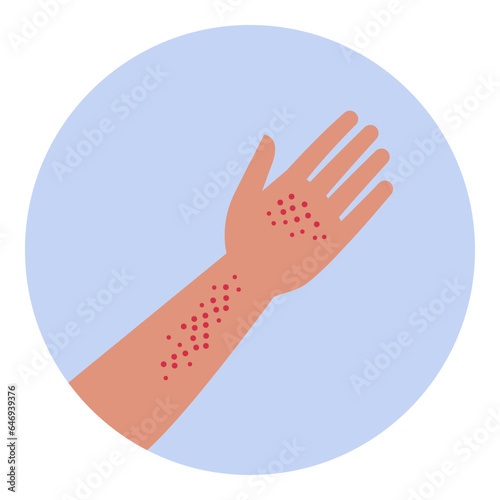 Rash on hand and arm skin