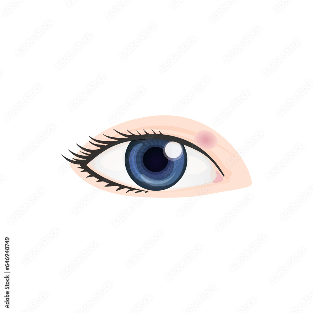 Chalazion Concept Design. Vector Illustration. Chalazion Concept Design. Vector Illustration.