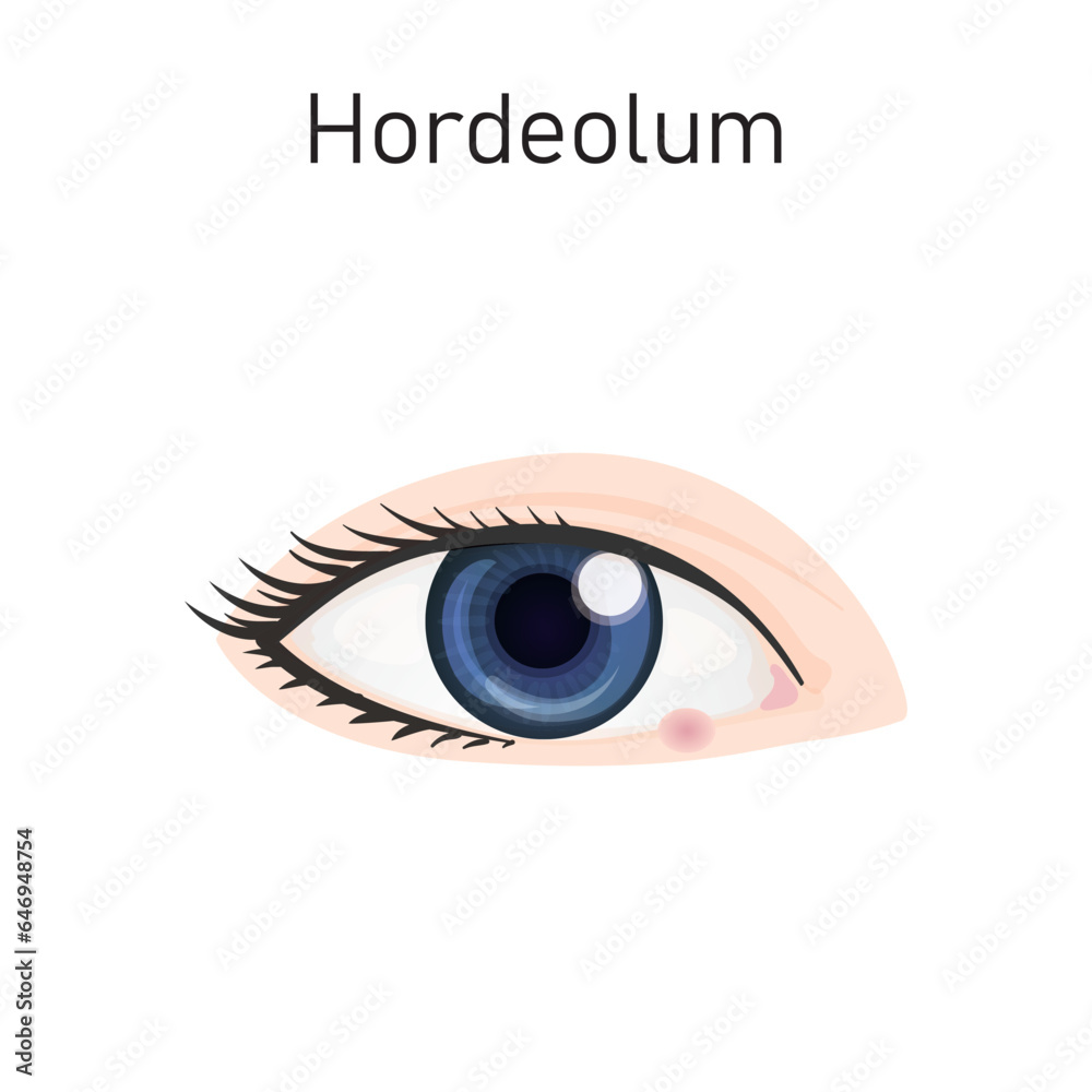 Hordeolum Concept Design. Vector Illustration. Hordeolum Concept Design. Vector Illustration.