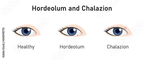 Hordeolum and Chalazion Concept Design. Vector Illustration.