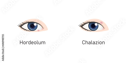 Hordeolum and Chalazion Concept Design. Vector Illustration.