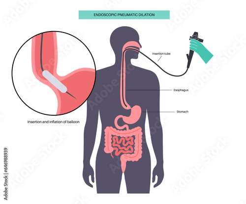 Endoscopic pneumatic dilation