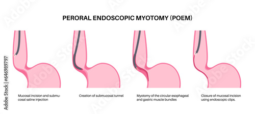 POEM medical poster