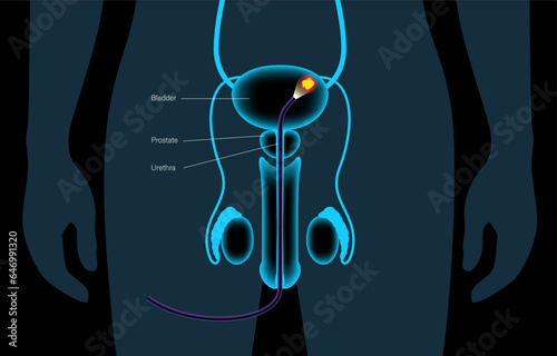 Cystoscopy examination concept