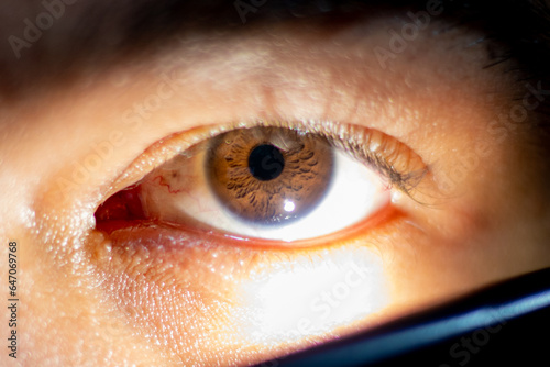 exposure of the iris of the eye